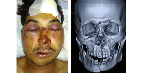 Facial-Trauma image