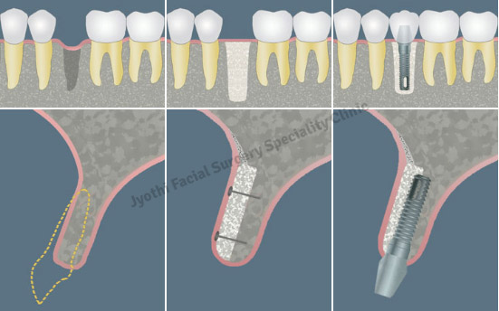 Major Bone Grafting