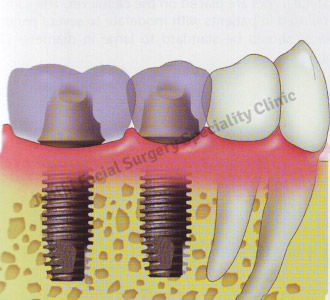 Dental Implants