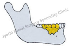 Dentoalveolar Trauma