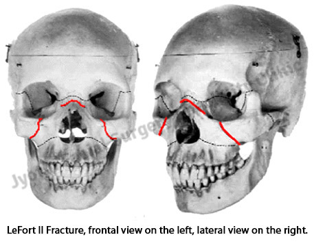 LeFort II Fracture