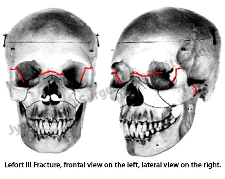 Lefort III Fracture