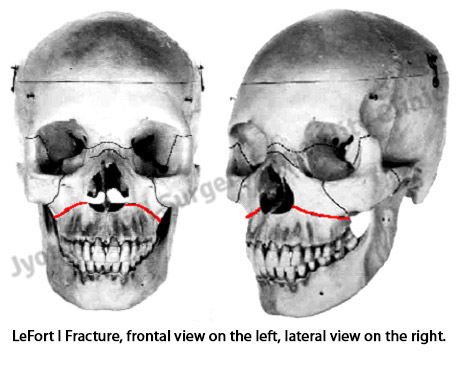  LeFort I Fracture