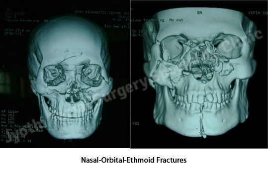 Nasal-Orbital