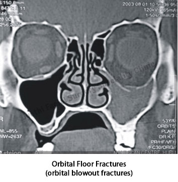 Nasal-Orbital