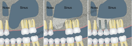 Sinus Lift Procedure