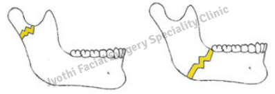 Dentoalveolar Trauma