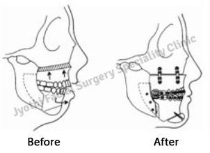 Surgical Correction