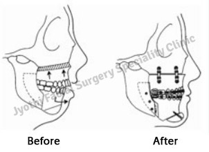 Surgical Correction