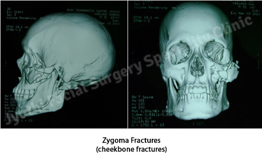 Zygoma-Fractures